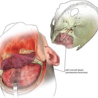 Craniofacial Tumour Surgeries by Dr. Prashant Khandelwal