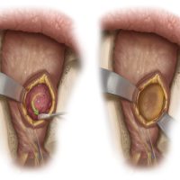 orbitaltumour